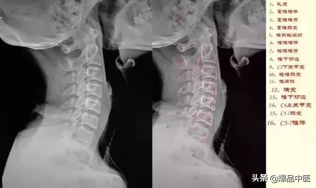 这样看颈椎X线，你也能成为高手