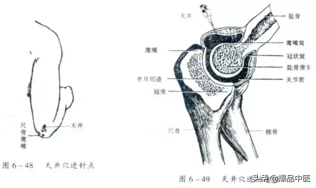关节穿刺技巧「髋、膝、踝、肩、肘、腕」