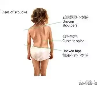 为什么会有高低肩!长短腿?