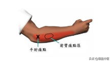 针灸治痛秒杀系列（网球肘）