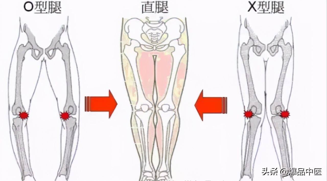 最全膝关节疼痛分析与临床「干货」