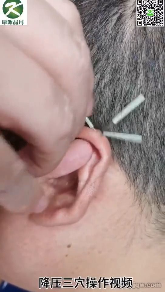 耳穴疗法：降压三针