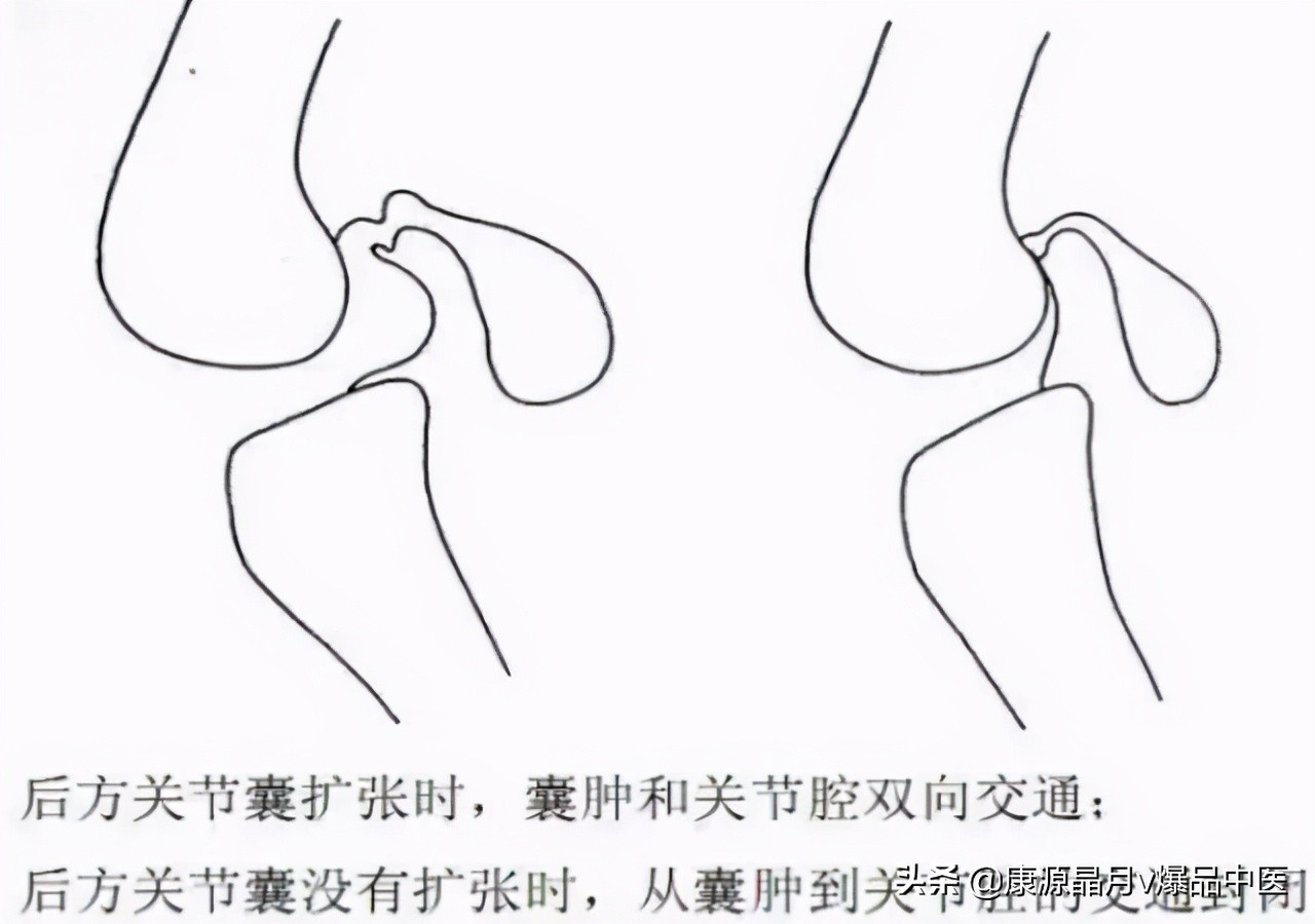 22种引起膝关节疼痛的常见疾病