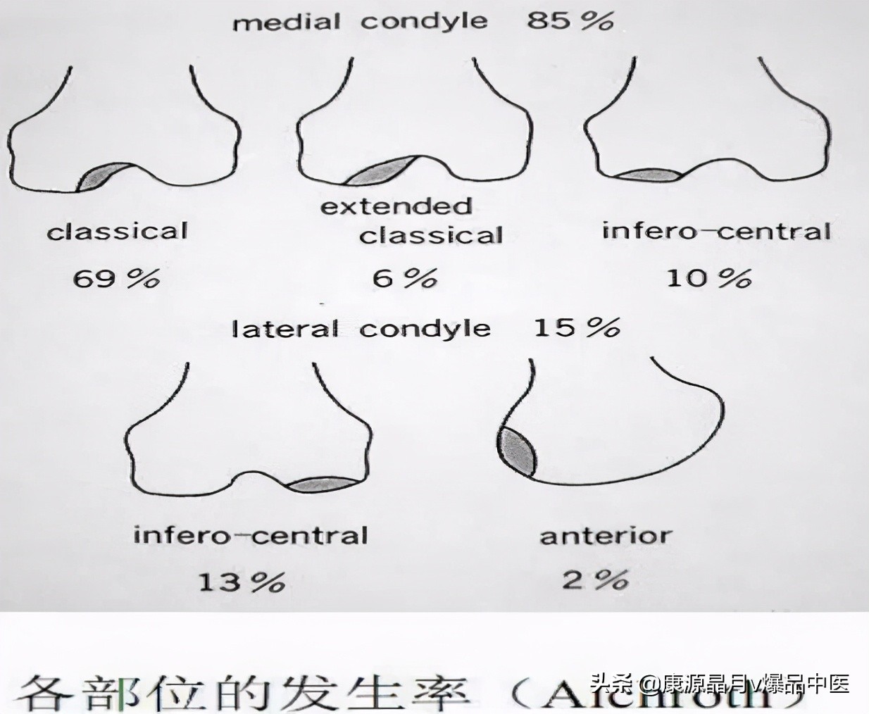 22种引起膝关节疼痛的常见疾病