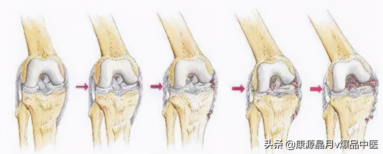 22种引起膝关节疼痛的常见疾病