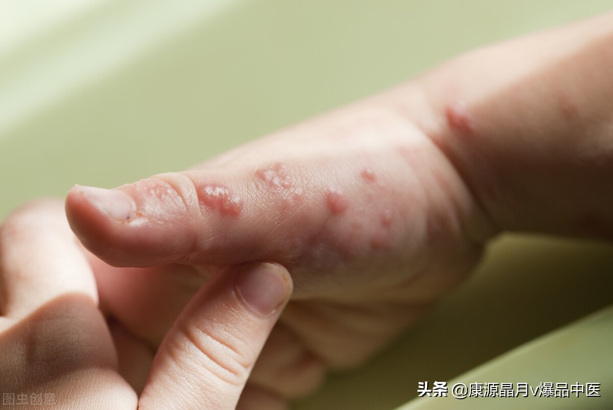 实用：火针治疗的经验收集
