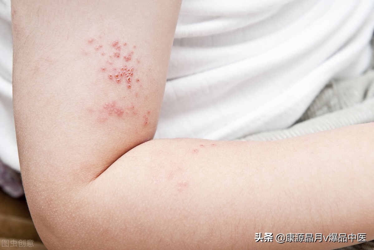 针灸治疗7种顽固皮肤病大全