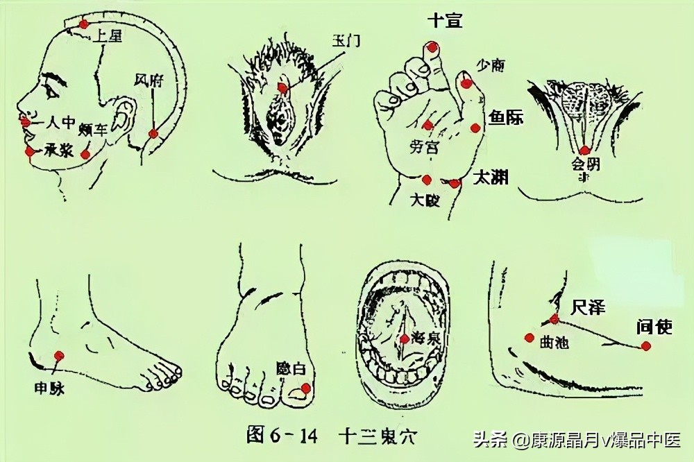 针灸“十三鬼穴”