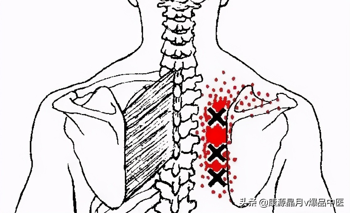 肩胛骨内侧缘痛的简单分析