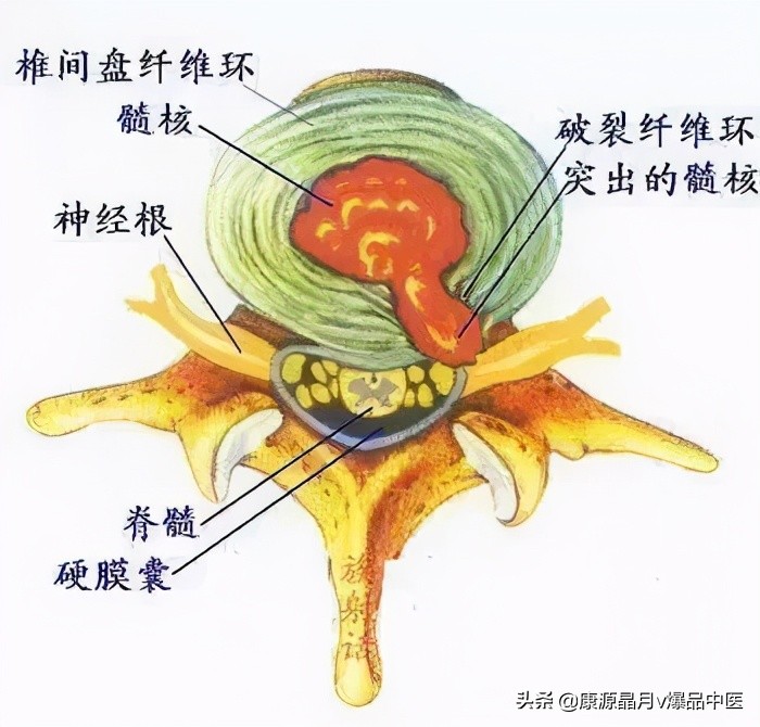 肩膀疼痛 原来不是肩周炎而是神经根型颈椎病