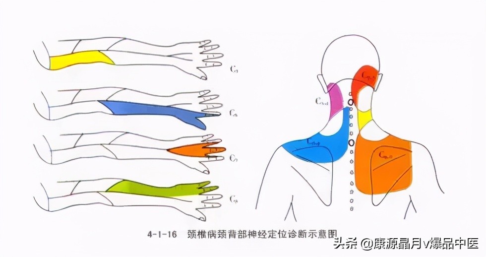 肩膀疼痛 原来不是肩周炎而是神经根型颈椎病