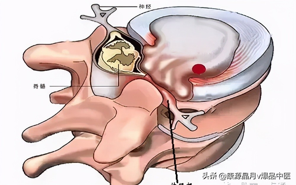 肩膀疼痛 原来不是肩周炎而是神经根型颈椎病