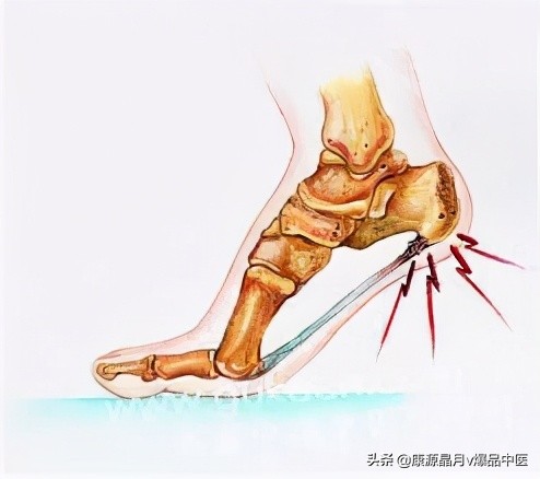 足跟痛的诊断与治疗要点