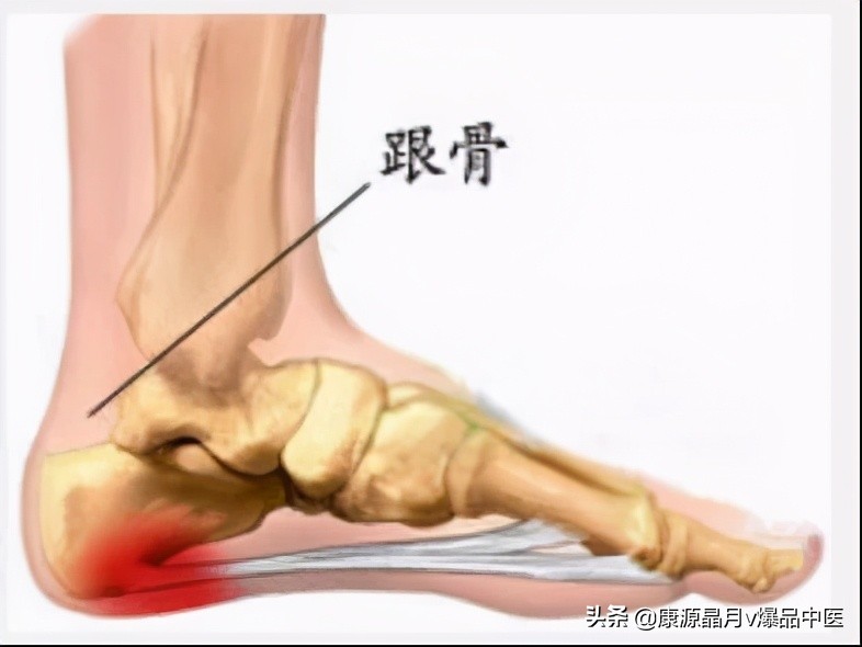 足跟痛的诊断与治疗要点