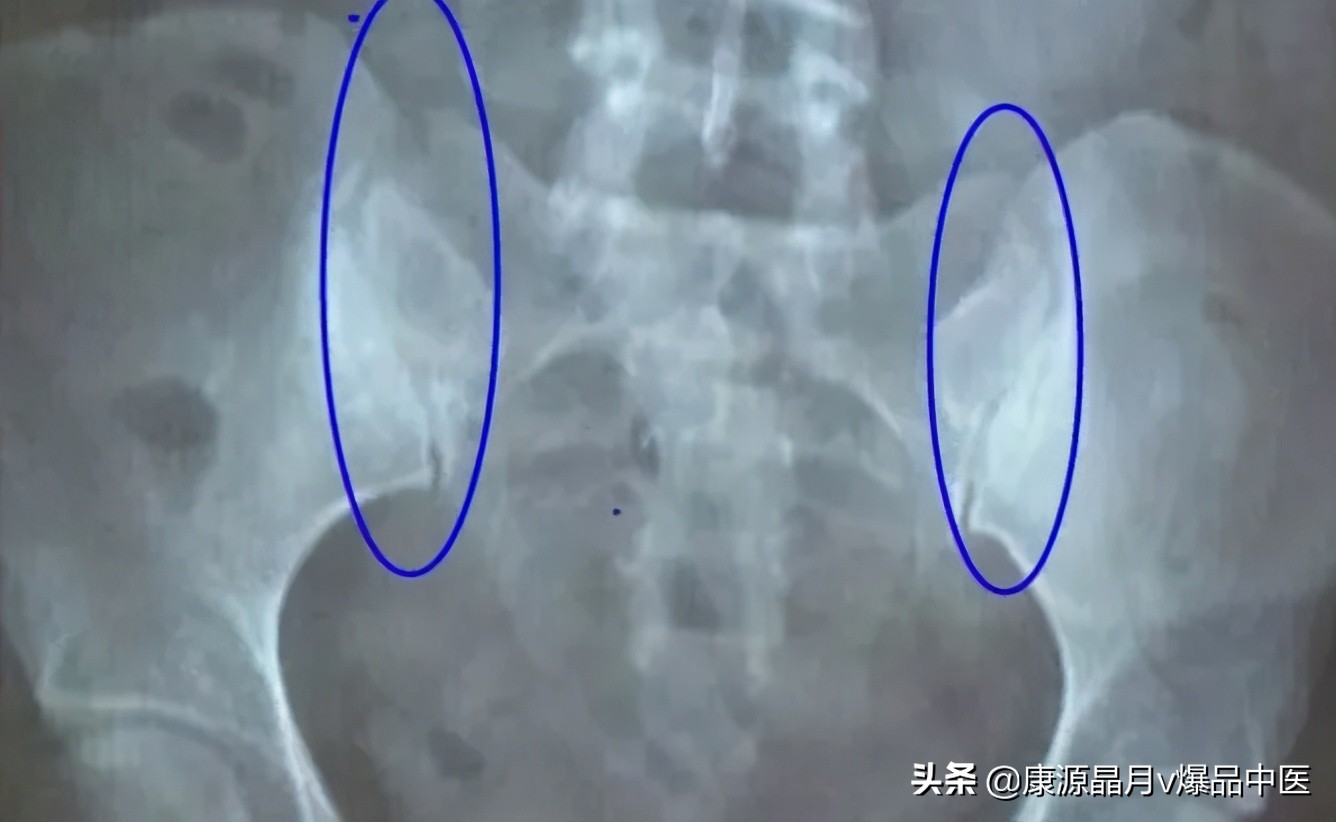 分析骶髂关节疼痛