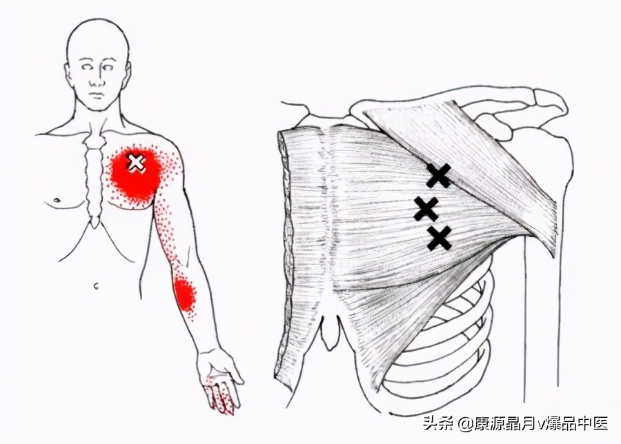 28块肌肉的常见激痛点以及疼痛模式