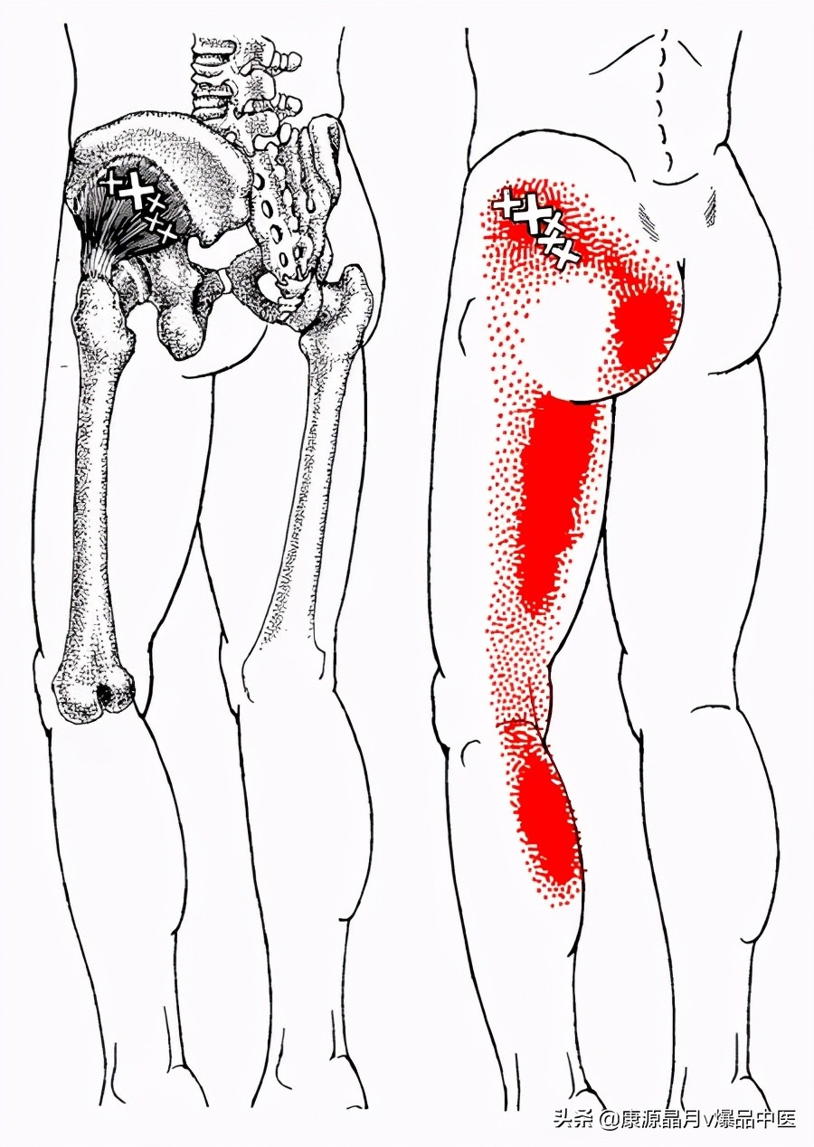 28块肌肉的常见激痛点以及疼痛模式