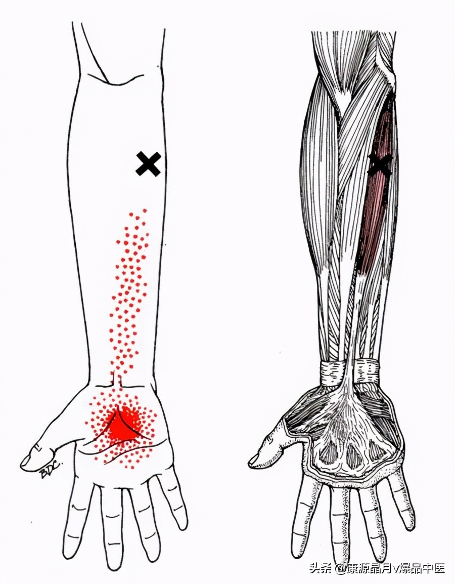 28块肌肉的常见激痛点以及疼痛模式