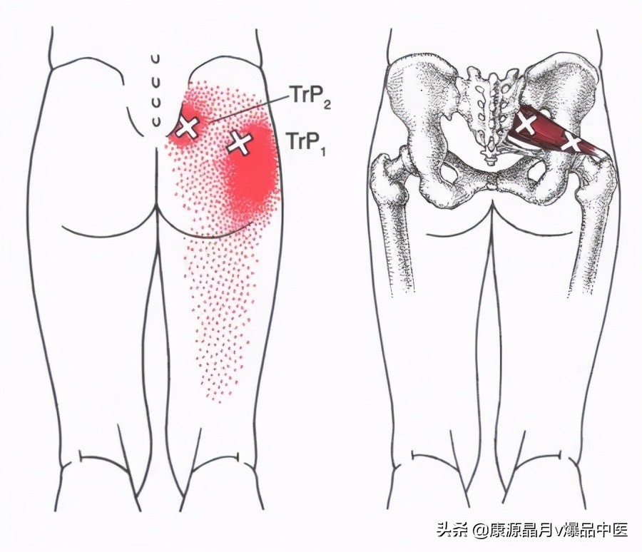 28块肌肉的常见激痛点以及疼痛模式