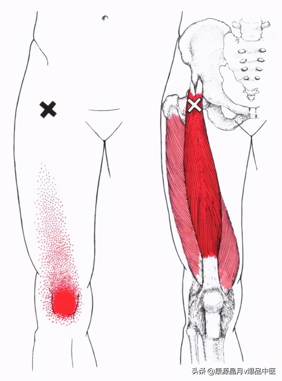 28块肌肉的常见激痛点以及疼痛模式