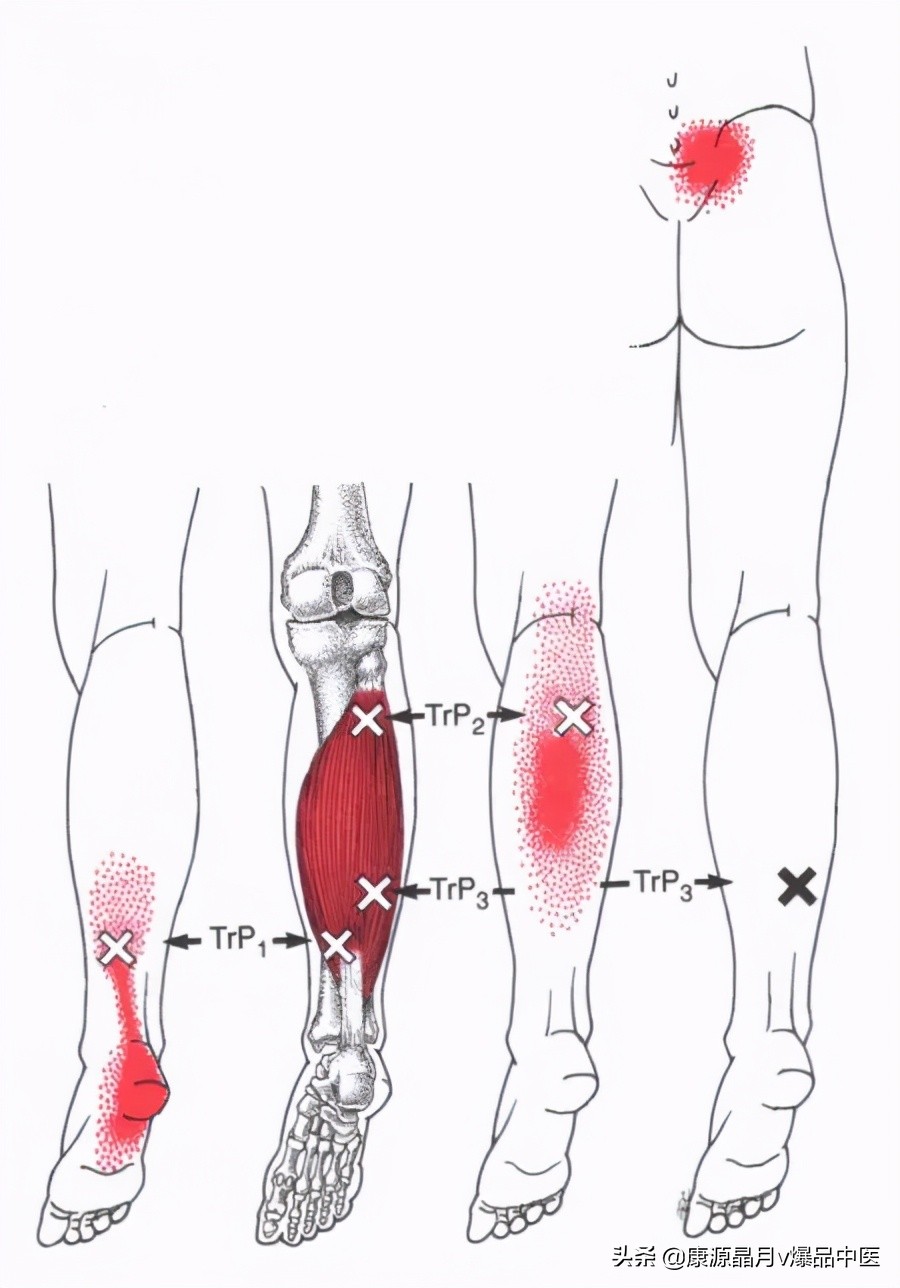 28块肌肉的常见激痛点以及疼痛模式
