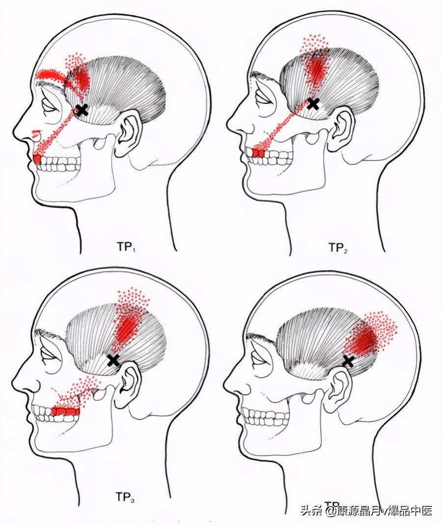 28块肌肉的常见激痛点以及疼痛模式