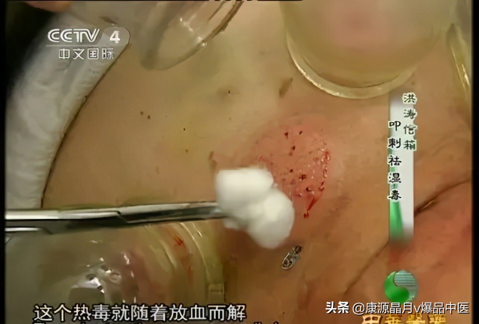 治疗“蛇盘腰”民间中医绝技！（收藏备用）