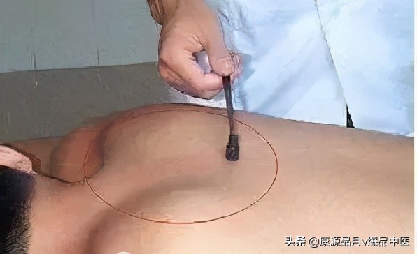 治疗“蛇盘腰”民间中医绝技！（收藏备用）
