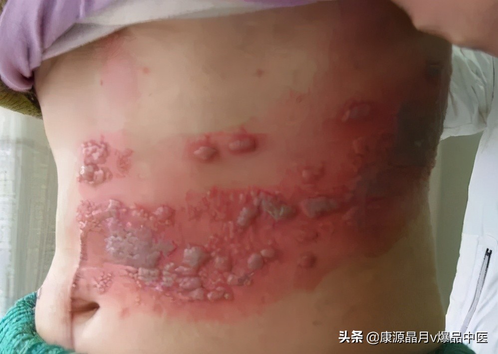 治疗“蛇盘腰”民间中医绝技！（收藏备用）