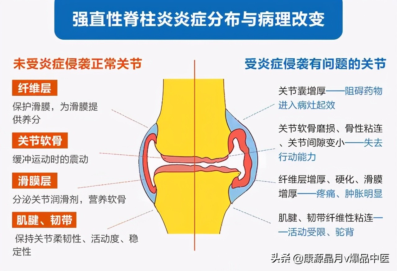 “强直性脊柱炎”太难治！这10点经验助你一臂之力