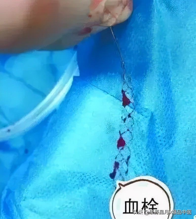 脚上有个“化血栓开关”，打开它，就可清血管、防血栓