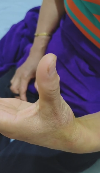 腱鞘炎，只扎了两针，完全不痛了