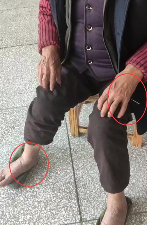 浑身串疼20天，扎止痛胡四针
