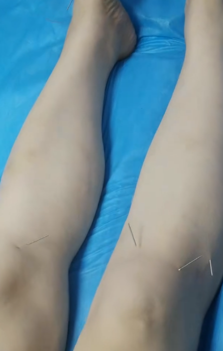 体针加耳针，椎间盘突出压迫神经