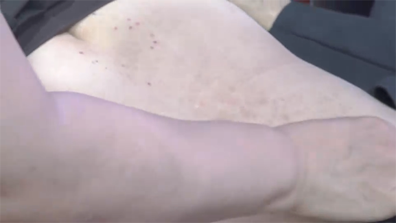 这个部位，千万不要双侧都做！