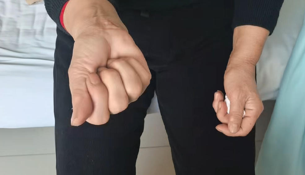 患者手麻，超微加中药4天